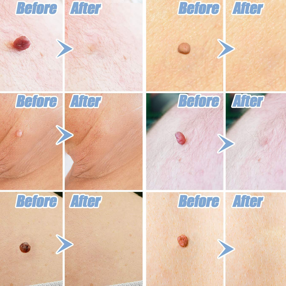 Skin Tag Remover
