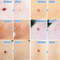 Skin Tag Remover