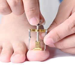 ingrown toe nail fixer device