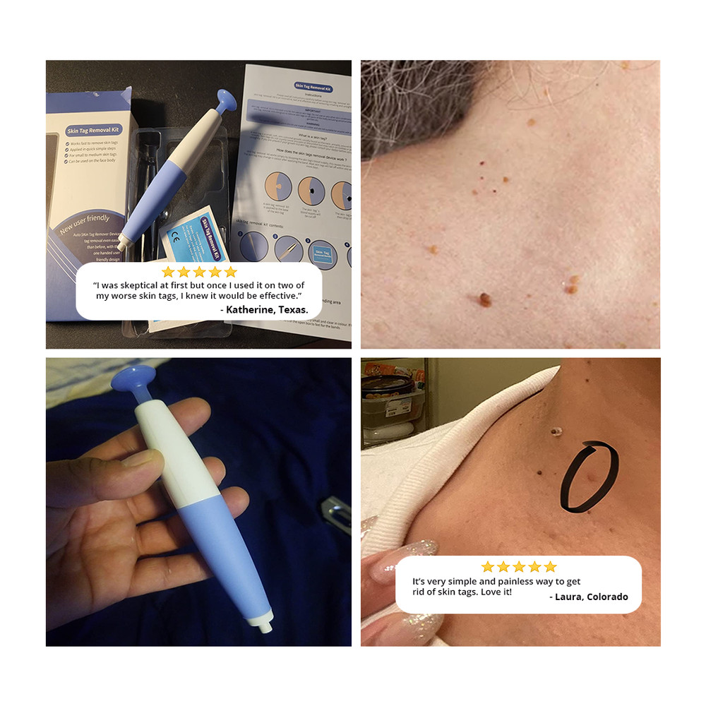Skin Tag Removal Kit