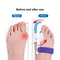 bunioncorrectorformenandwomen5.png