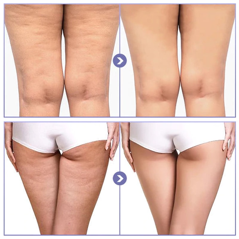 skinniertighteningcellulitereducingthighpatch5png