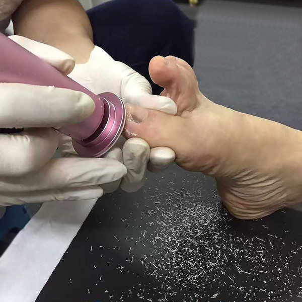 Professional Callus Remover For Soft Feet - Inspire Uplift