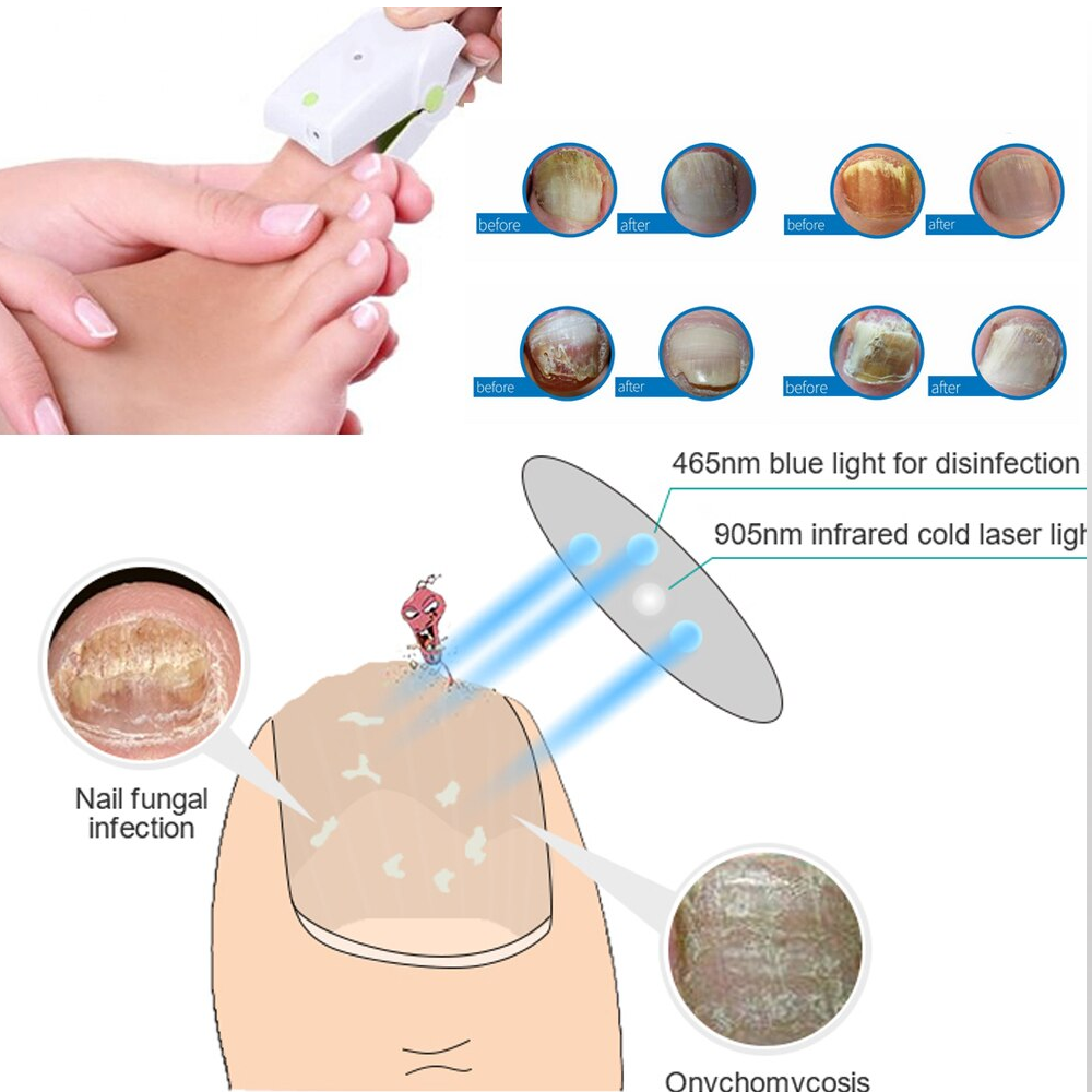 nailfunguslaserdevice5.png