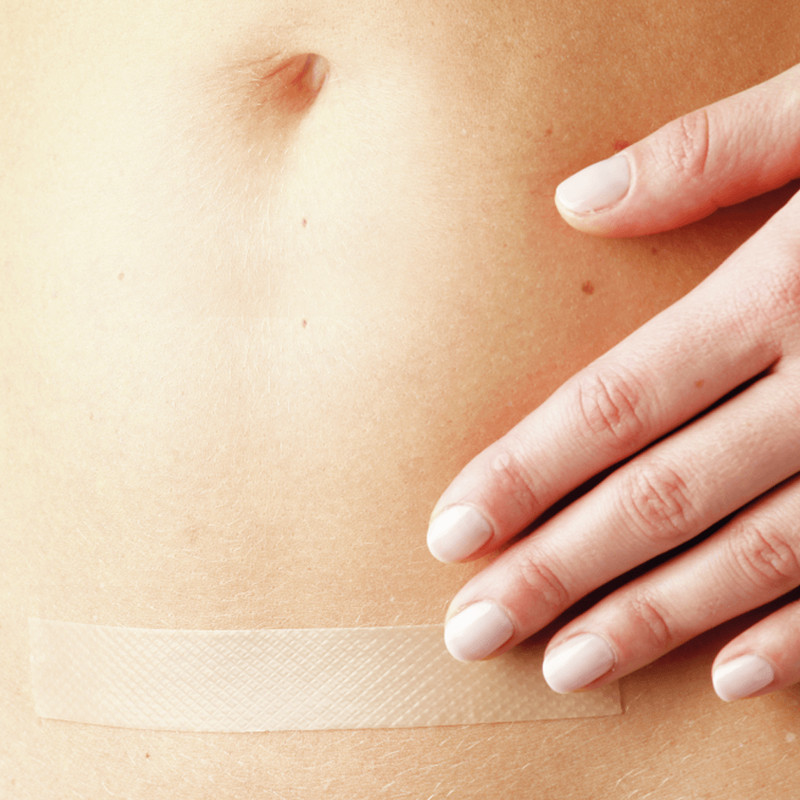 Application of Medical Silicone Gel Tape on arm scar