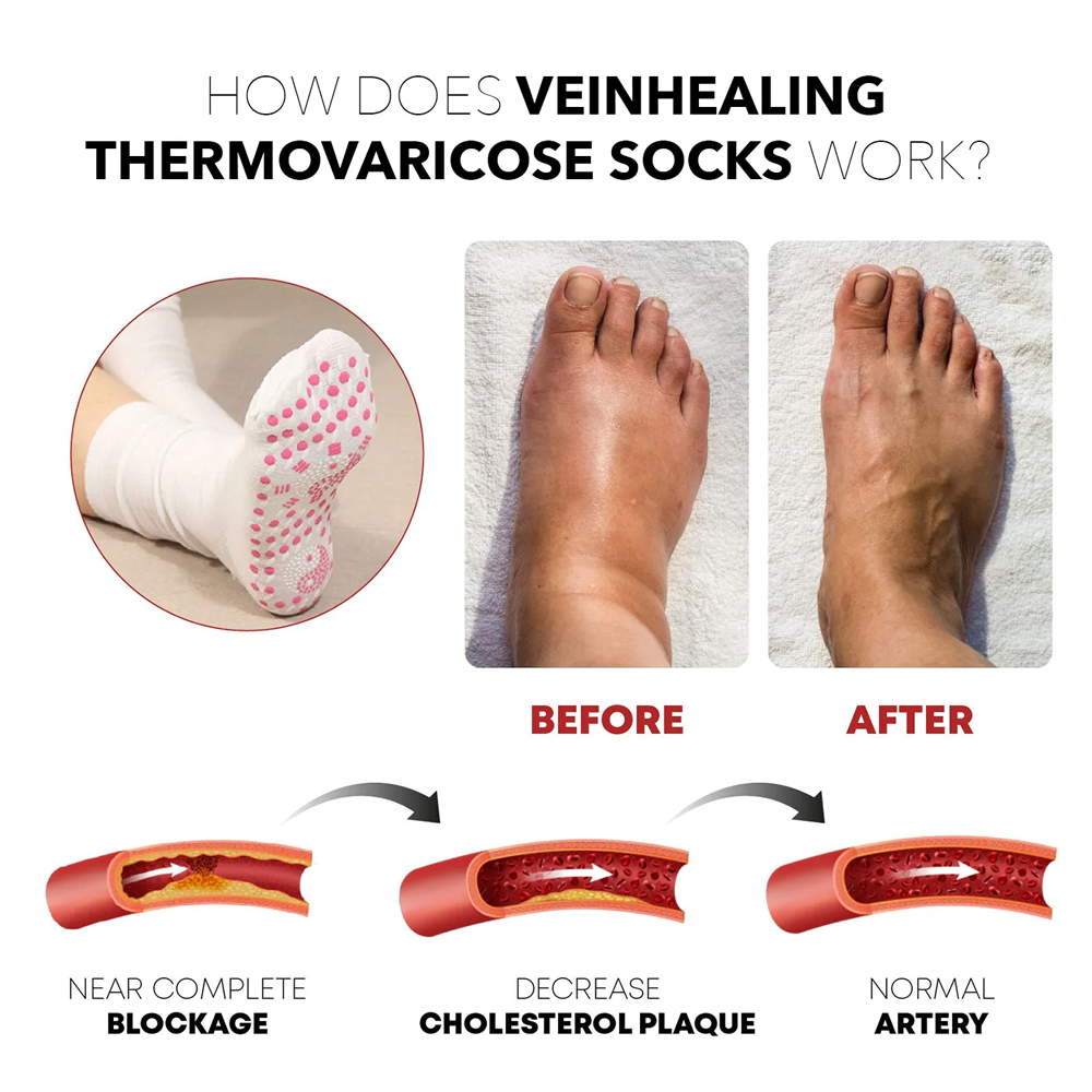 veinhealingthermovaricosesocks3.png