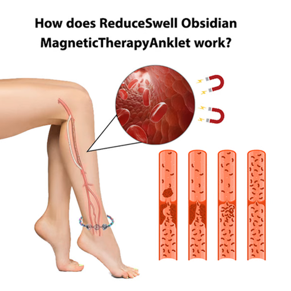 Magnetic therapy anklet for varicose veins