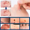 Effective skin tag stickers for quick removal