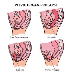 pelvic organ prolapse variously video education animation