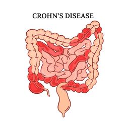 CROHN DISEASE VIDEO Intestinal Medicine Anatomy Animation