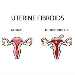 uterine fibroids vs normal video female reproductive scheme