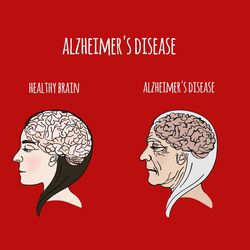 ALZHEIMER DISEASE VIDEO Memory Loss Medical Education Clip