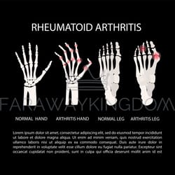 arthritis hand leg rheumatoid medicine education vector scheme