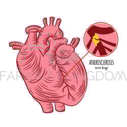 atherosclerosis chronic disease medicine education diagram