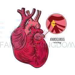 atherosclerosis disease chronic illness medicine education diagram
