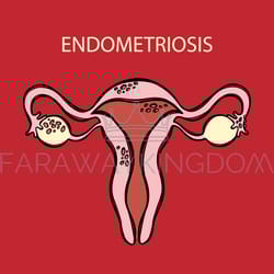 endometriosis female reproductive system medicine education