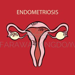 ENDOMETRIOSIS Female Reproductive System Medicine Education