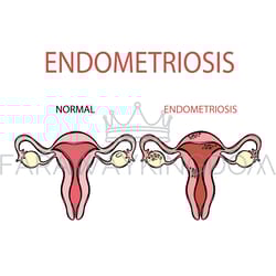 endometriosis normal female reproductive system education