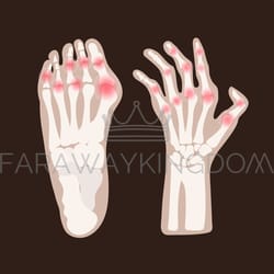 hand leg arthritis rheumatoid medicine education vector scheme