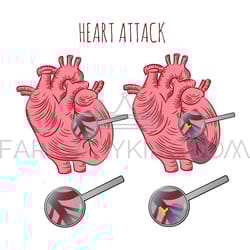 heart attack atherosclerosis medicine education vector scheme