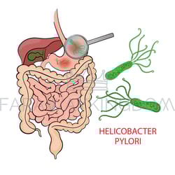 helicobacter pylori medicine education diagram vector set