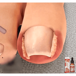 nailhelper ingrowth toenail correction treatment oil