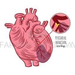 MYOCARDIAL INFARCTION SCHEME Heart Attack Medicine Education