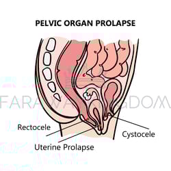 pelvic organ prolapse medical education scheme vector set