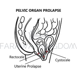 pelvic organ prolapse monochrome education scheme vector set