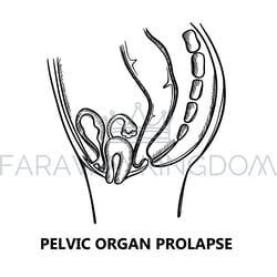 pelvic organ prolapse sketch education scheme vector set