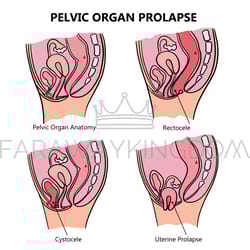 pelvic organ prolapse variously education scheme vector set