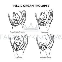 pelvic organ prolapse variously monochrome education vector set