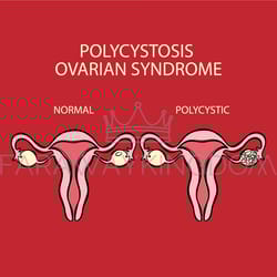 polycystic ovarian syndrome vs normal reproductive system