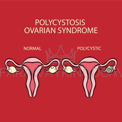 POLYCYSTIC OVARIAN SYNDROME VS NORMAL Reproductive System