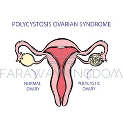 polycystosis ovarian syndrome female reproductive system