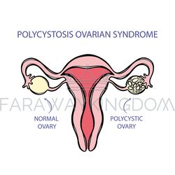 POLYCYSTOSIS OVARIAN SYNDROME Female Reproductive System
