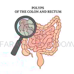 polyps of the colon intestines medicine anatomy vector scheme