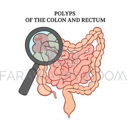 POLYPS OF THE COLON Intestines Medicine Anatomy Vector Scheme