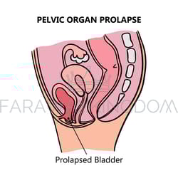 prolapsed bladder of women medical education scheme vector set