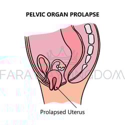 prolapsed uterus of women medical education scheme vector set