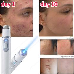 acne laser pen portable wrinkle removal machine durable soft scar remover device blue light therapy pen massage