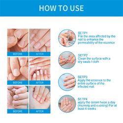 Repair Onychomycosis Paronychia Anti Infection Toenail New Nail Repair Solution Fungus Nails Treatment For Fingernails