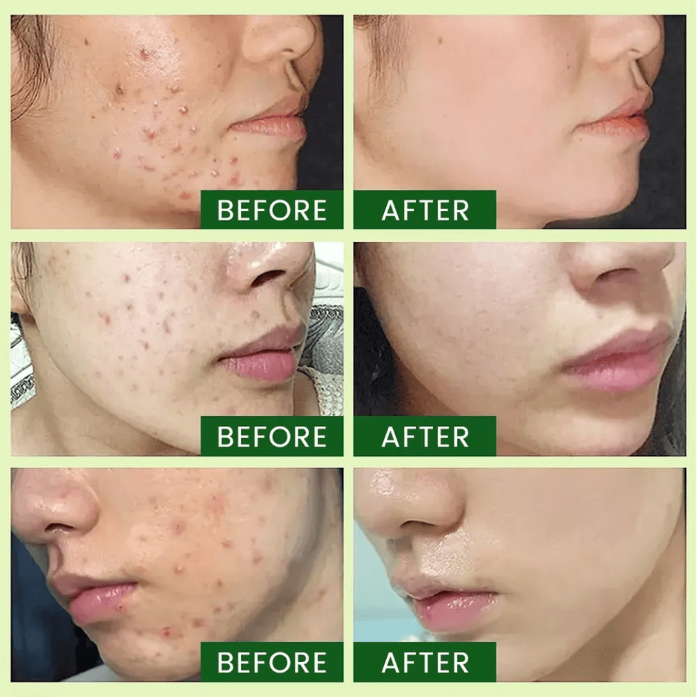 Tea Tree Serum Pure Niacinamide B3 Salicylic Hyaluronic Acid VC Organic Acne Treatment For Clear Ra 1