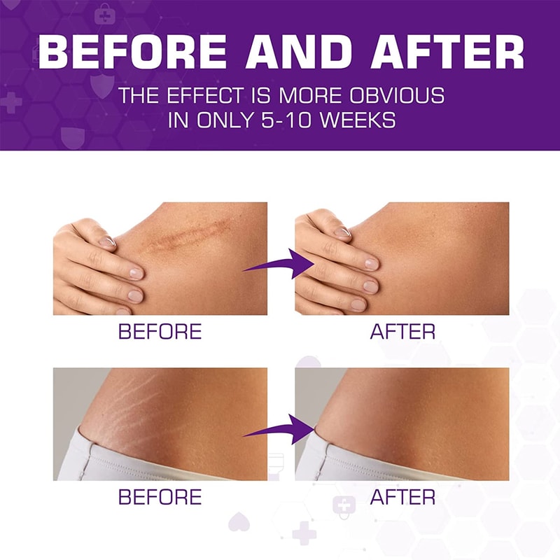Medical Grade Silicone Scar Sheets For Keloid Surgery Burn Healing 5