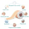 Advanced Silicone Scar Sheets Reusable Scar Repair Tape For Smooth Skin 3