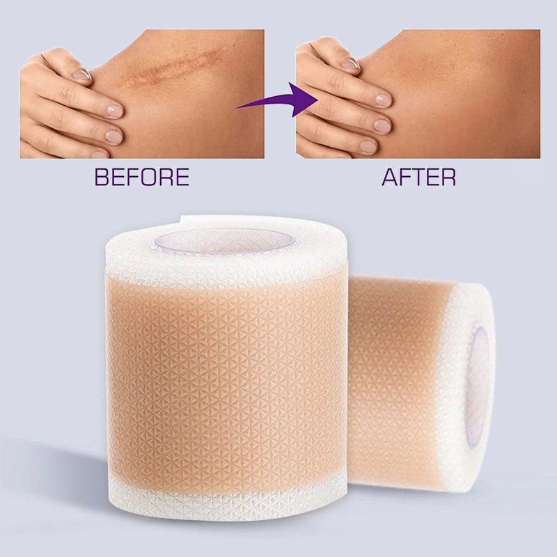 Advanced Silicone Scar Tape Waterproof Breathable Reusable Scar Patch For Skin Protection And Comf 0