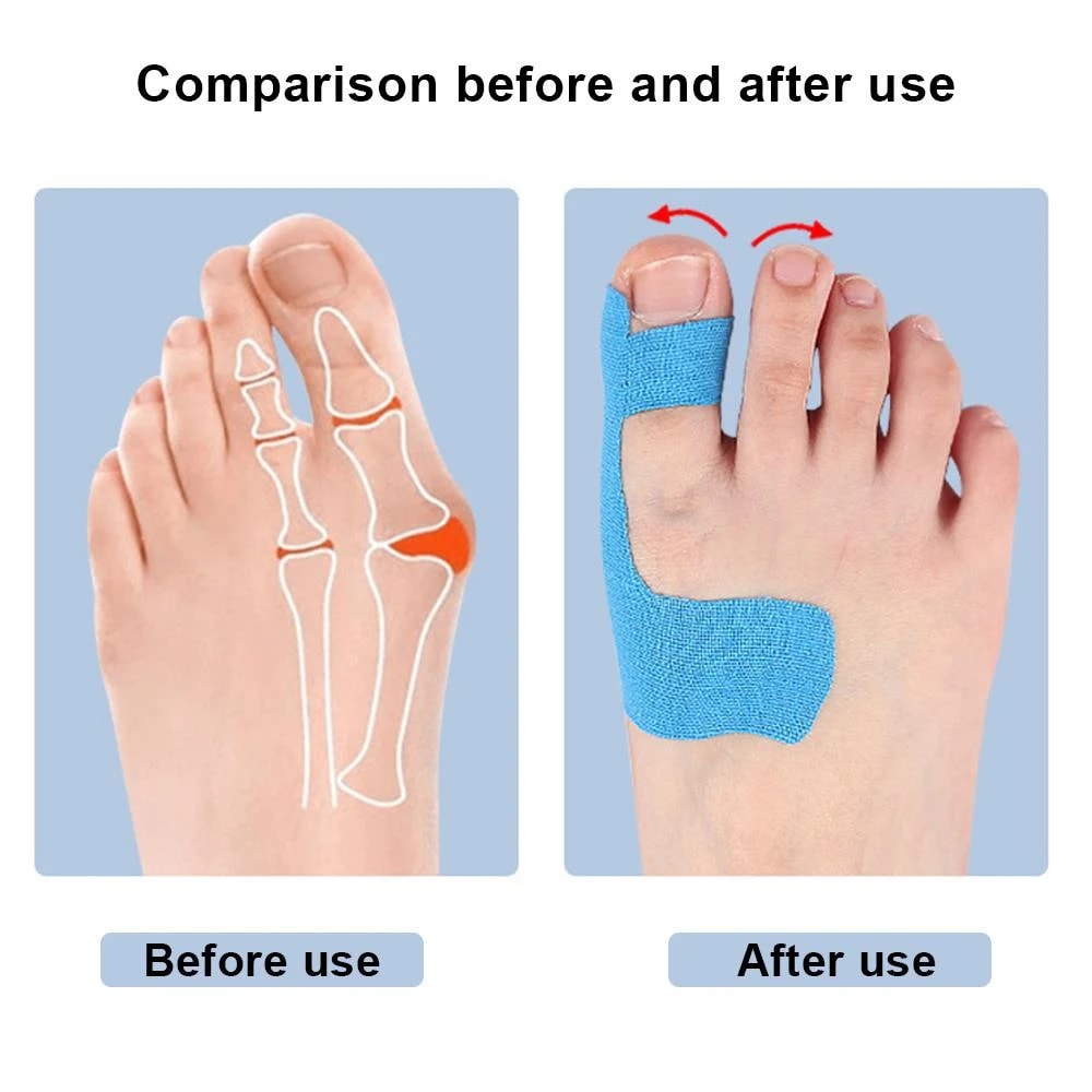 Premium Bunion Relief Tape Precut Bunion Corrector Tape For Toe Alignment Pain Support 2