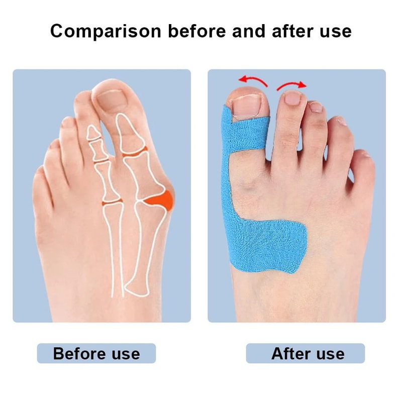 Premium Bunion Relief Tape Precut Bunion Corrector Tape For Toe Alignment Pain Support 2