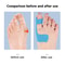 Self Adhesive Bunion Corrector Toe Separator For Hallux Valgus Relief For Men And Women 4