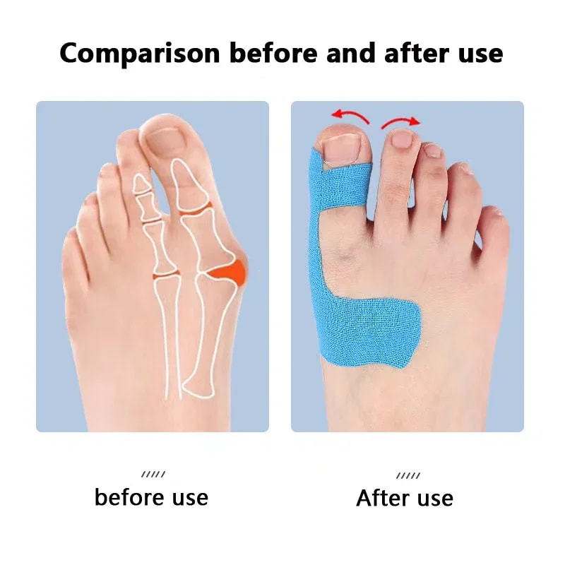 Self Adhesive Bunion Corrector Toe Separator For Hallux Valgus Relief For Men And Women 4